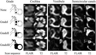 The Correlation of a 2D Volume-Referencing Endolymphatic-Hydrops Grading System With Extra-Tympanic Electrocochleography in Patients With Definite Ménière's Disease